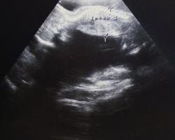 Síndrome de transfusión feto-fetal Síntomas clínicos del síndrome de transfusión feto-fetal