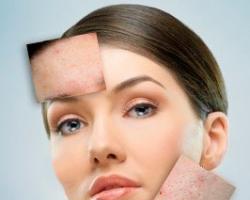 Cómo eliminar rápidamente las manchas de acné en la cara en casa Mascarillas faciales para después del acné